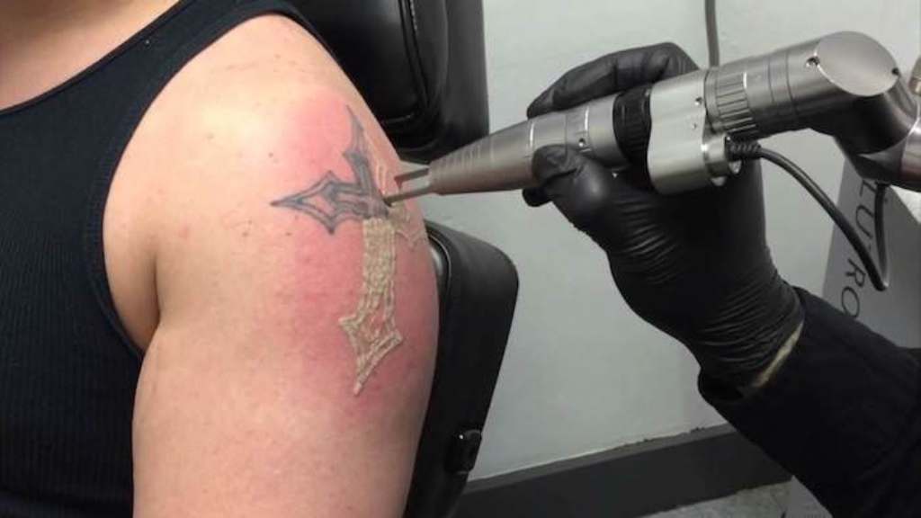Лазерное сведение татуировок