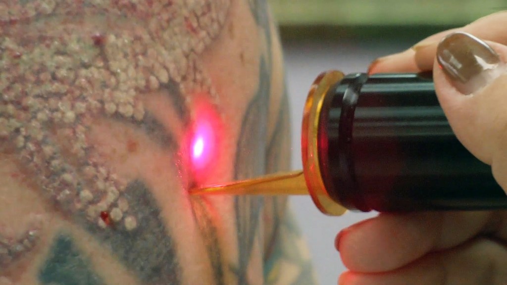 лазерное удаление тату