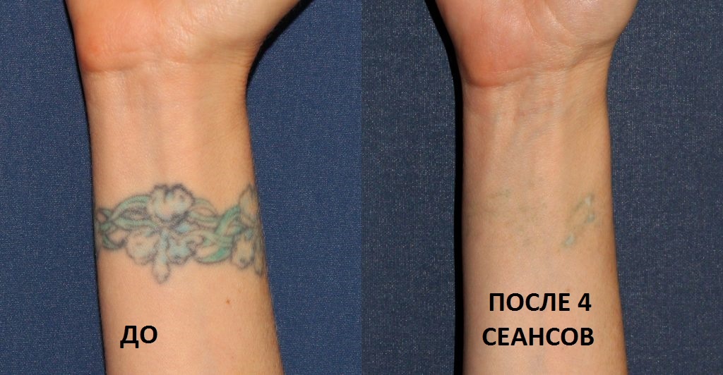 лазерное удаление татуировок